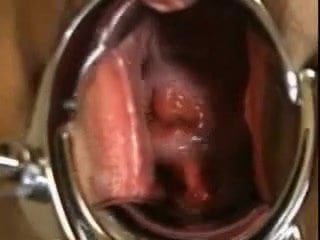 Japanese Extreme EW cervix, speculum, close-up